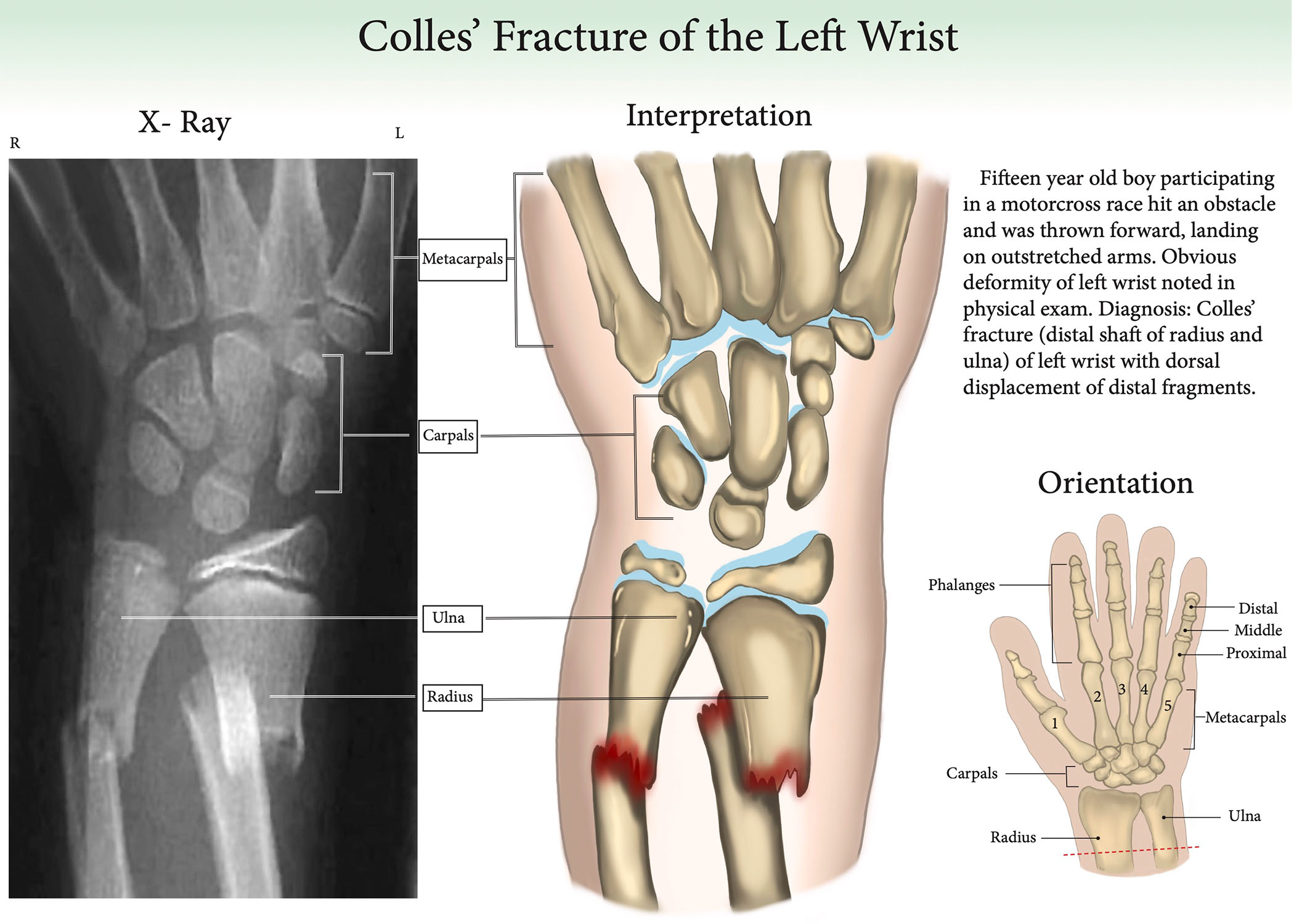 An illustration of a wrist fracture.