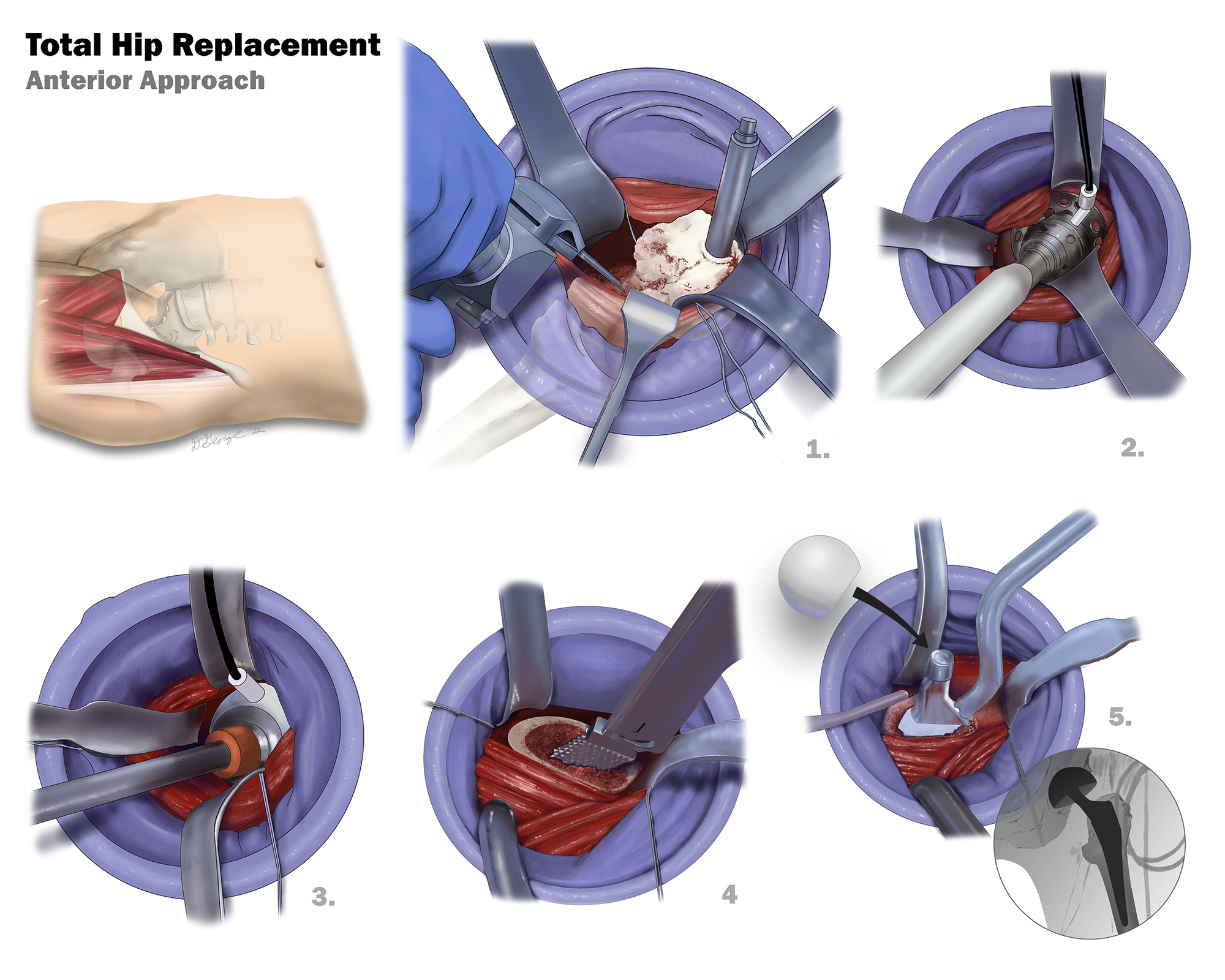 An illustration of a hip replacement.