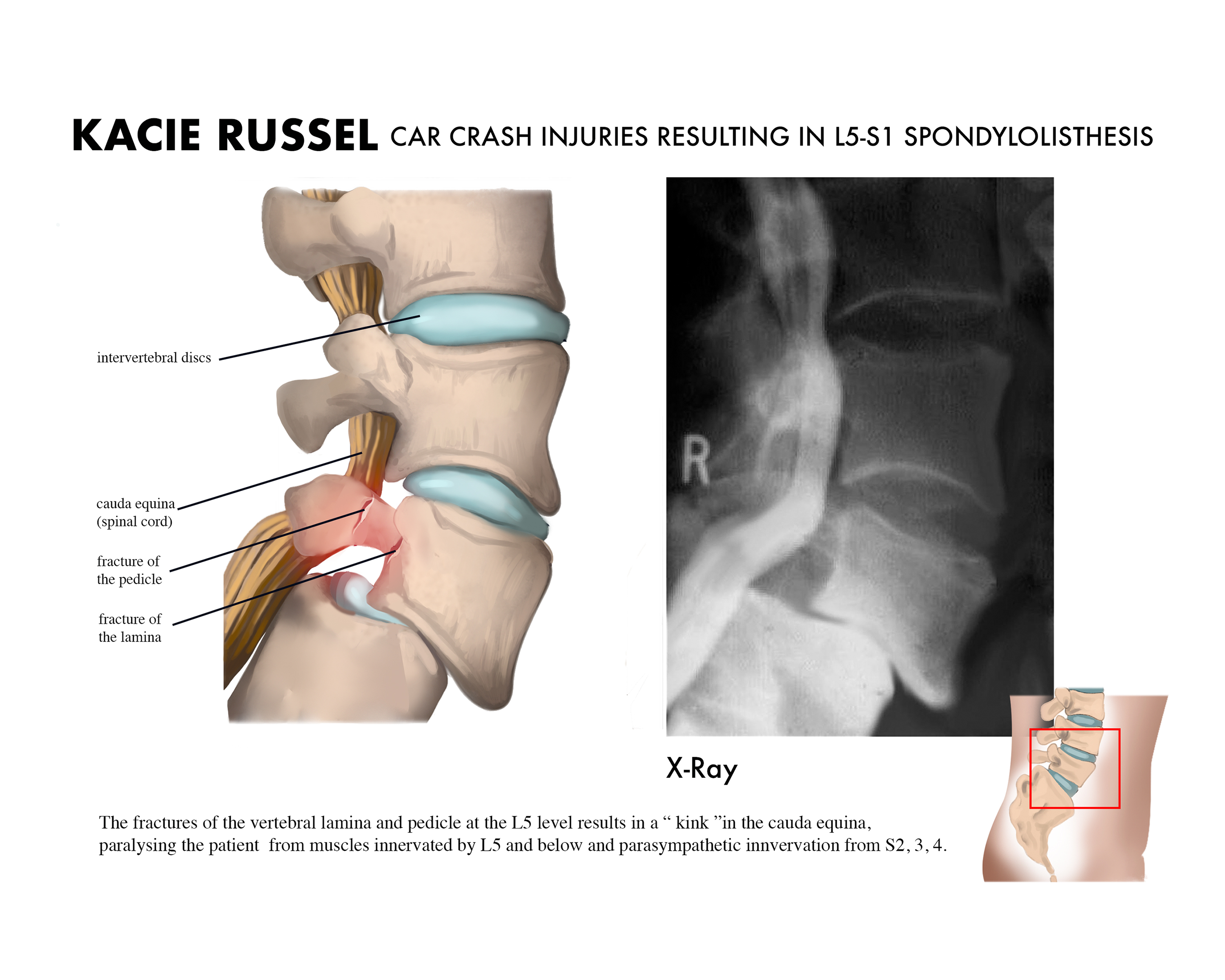 An illustration of a spine injury.