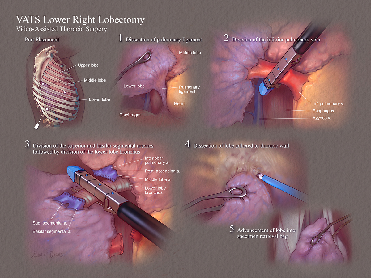 An illustration of video-assisted thoracic surgery.