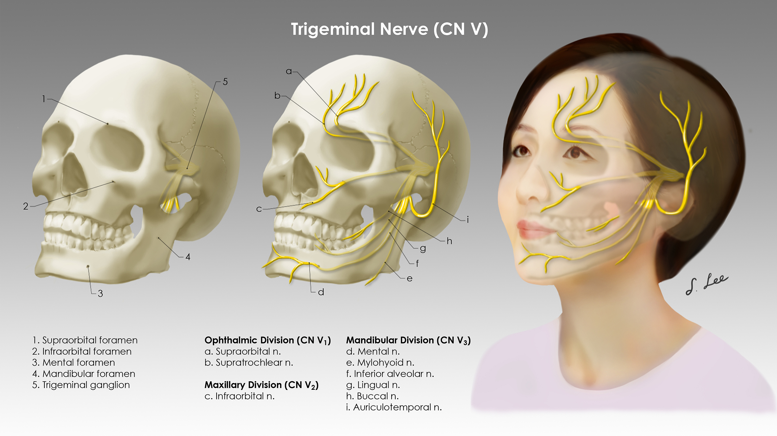An illustration of a trigminal nerve injury.