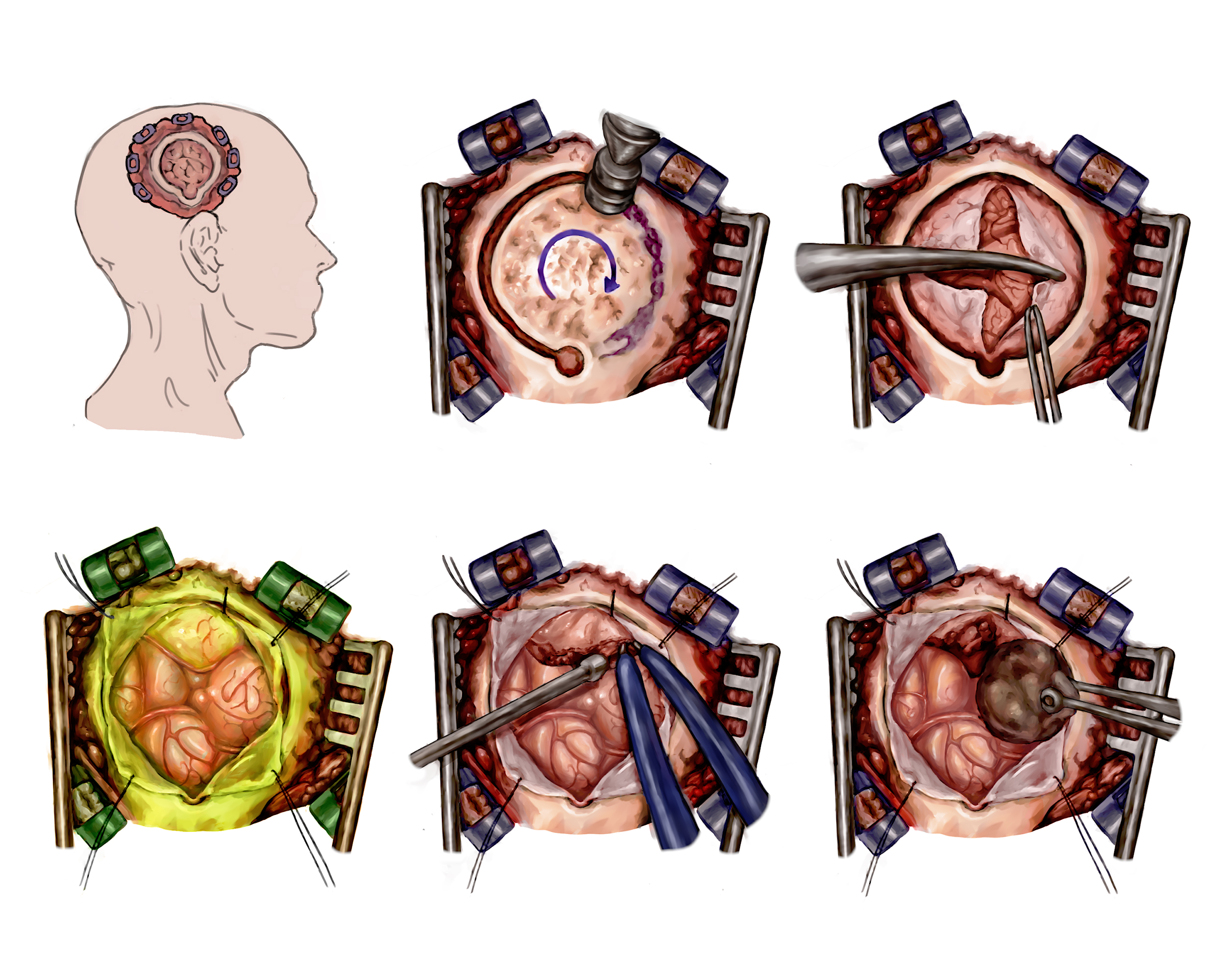 Illustrations of a human surgery.