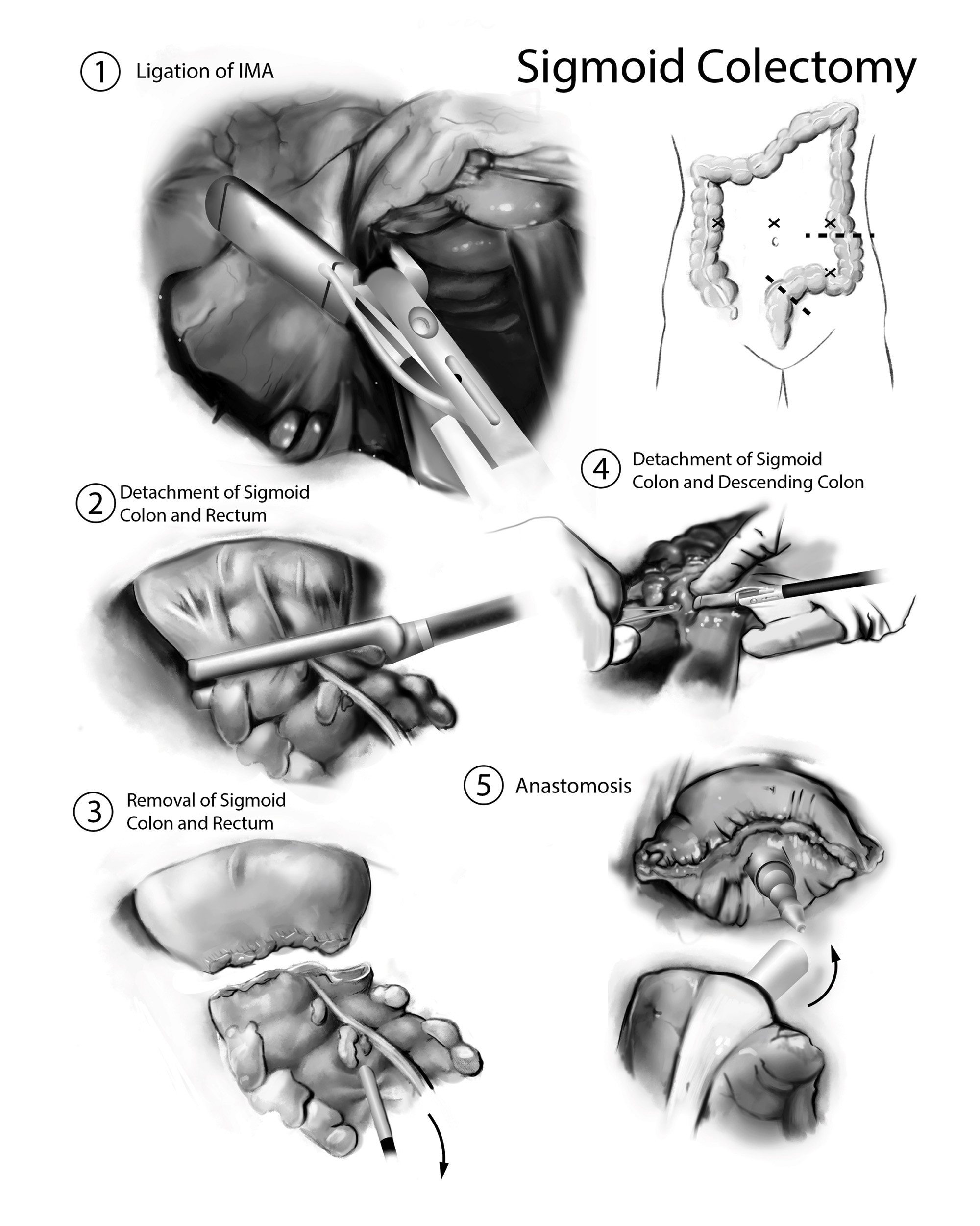 An illustration of sigmoid colectomy.