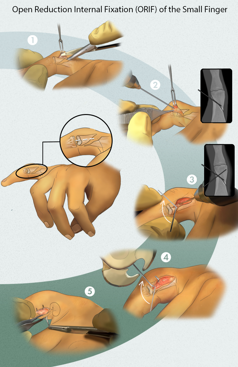 An illustration of open reduction internal fixation of the small finger.