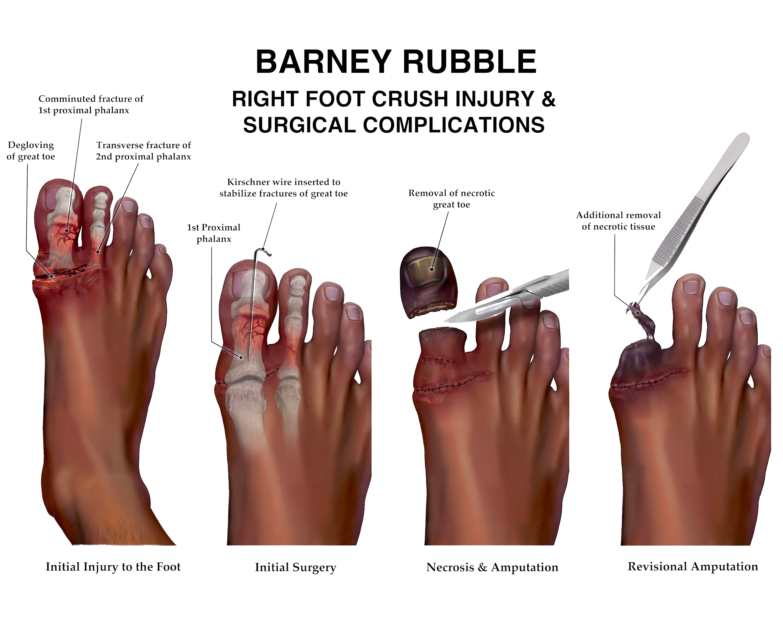 An illustration of an injured foot.