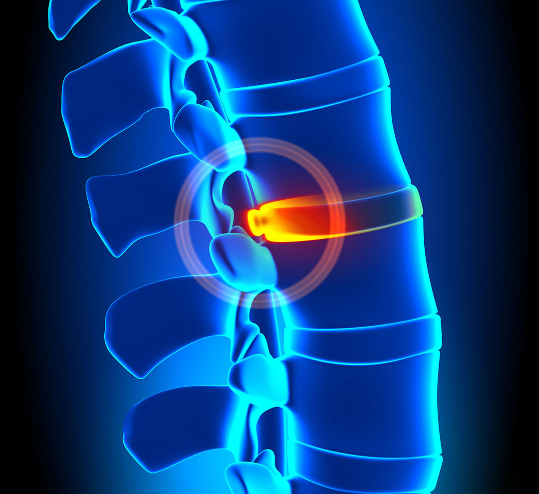 illustration of an irritated disc in a spine.