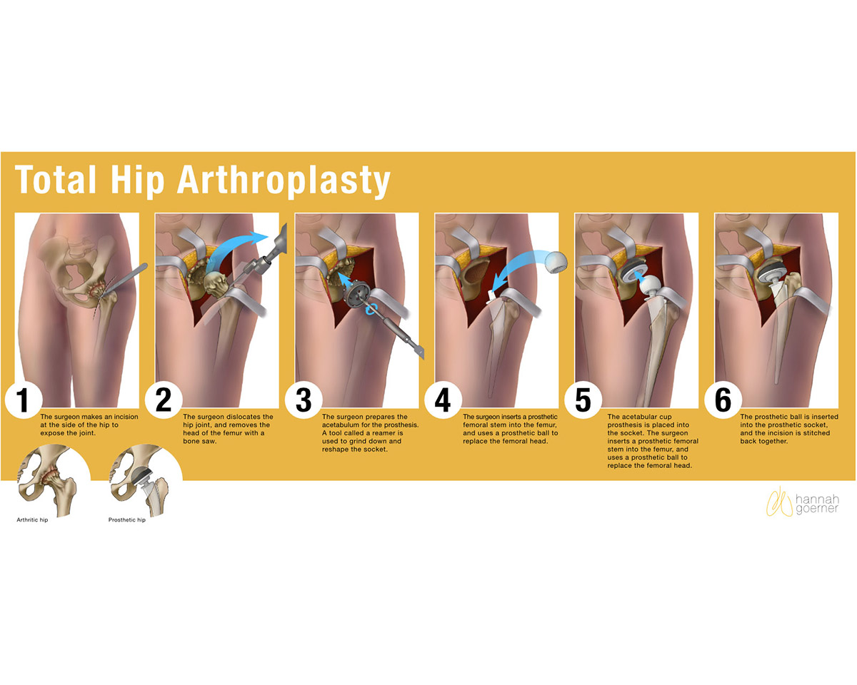 An illustration of total hip arthroplasty.