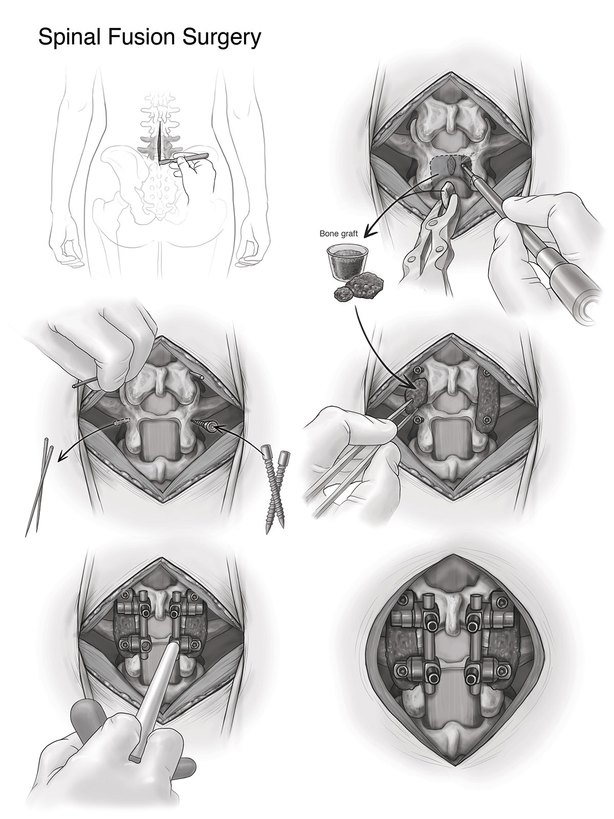 Illustration of spinal fusion surgery.