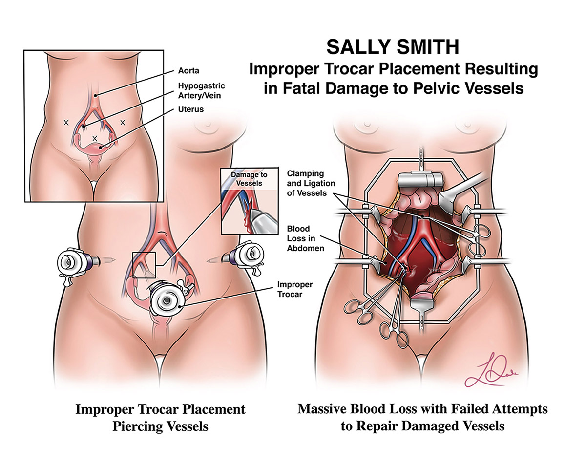Illustration of fatal damage to pelvic vessels.