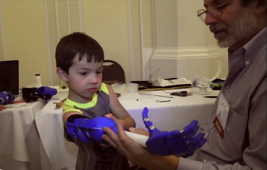 Child with prosthetic arm 