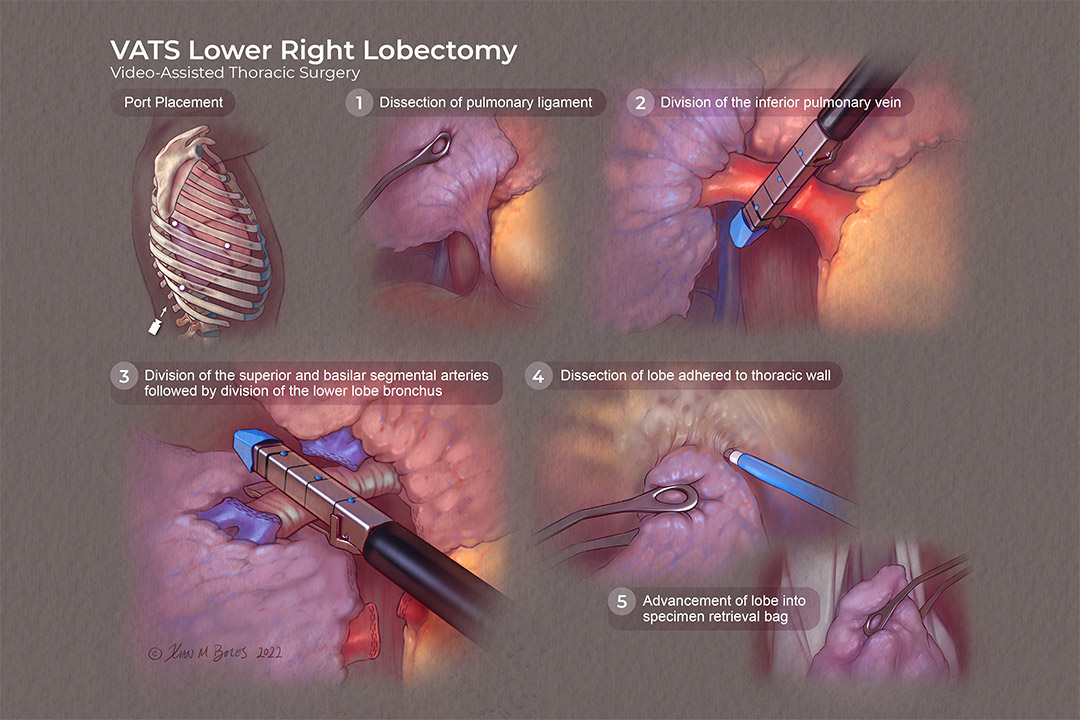 illustration showing five steps for video-assisted thoracic surgery, lower right lobectomy.