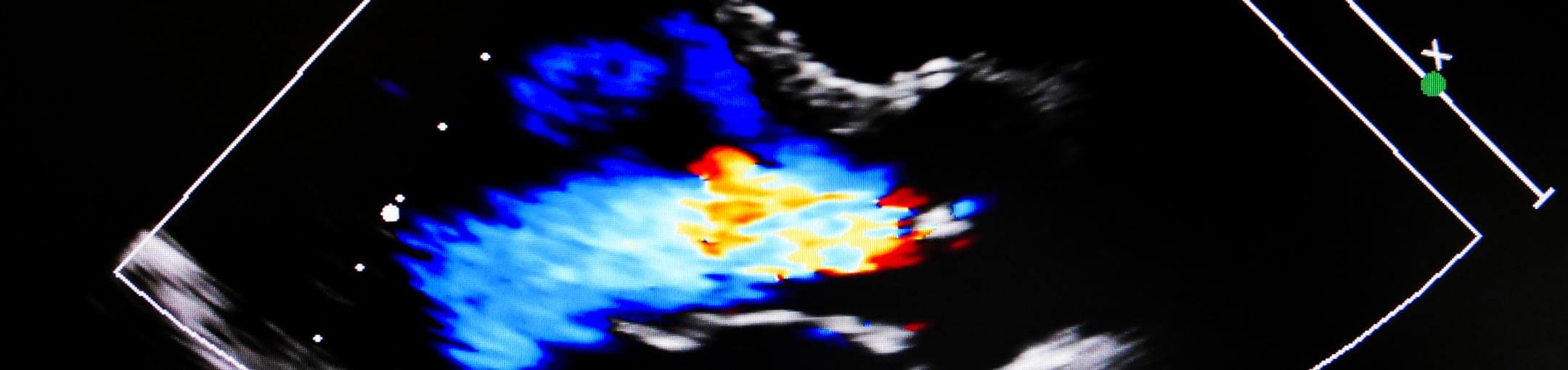 Colorful echocardiogram screen.