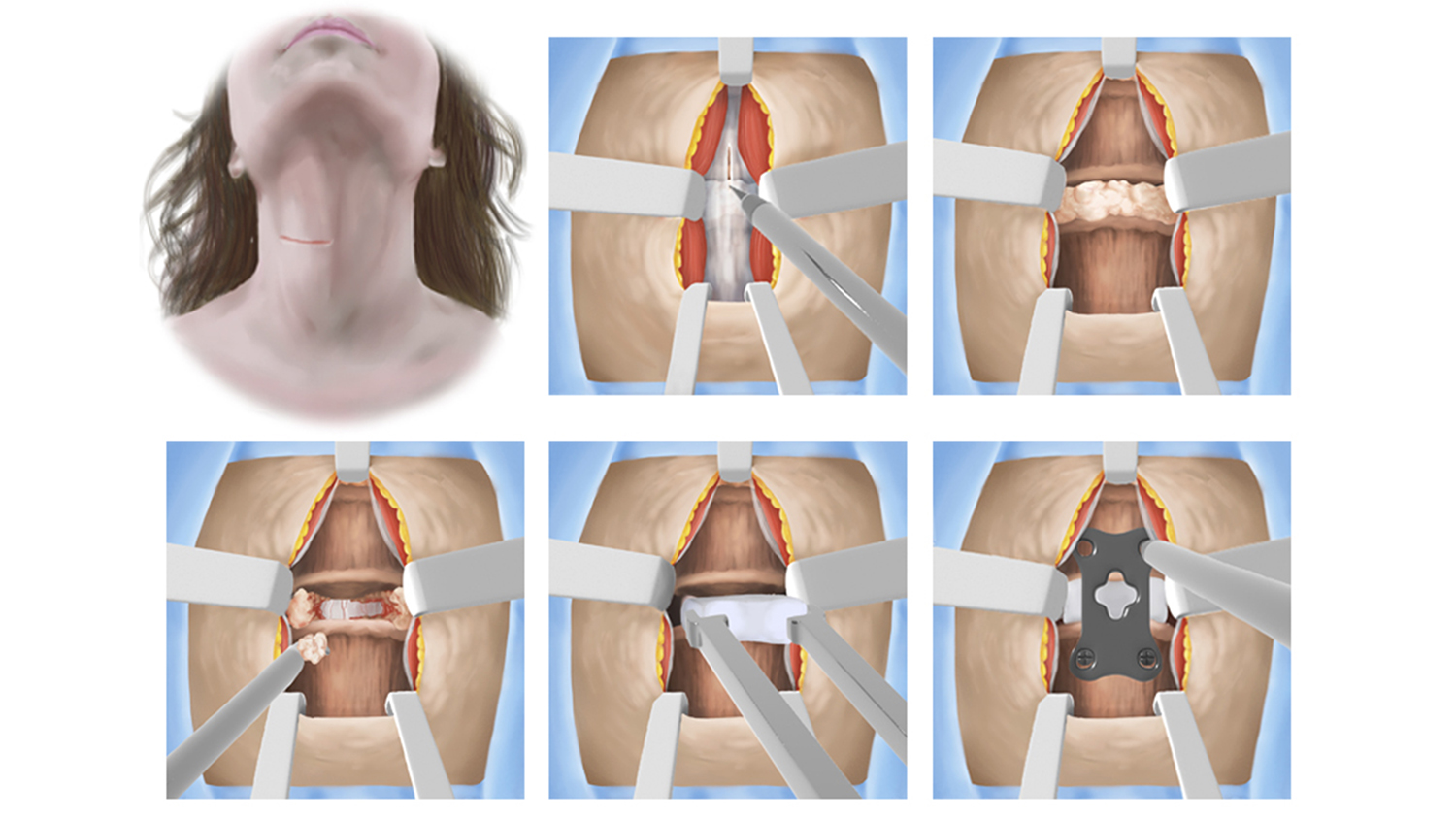 An illustration of a neck procedure
