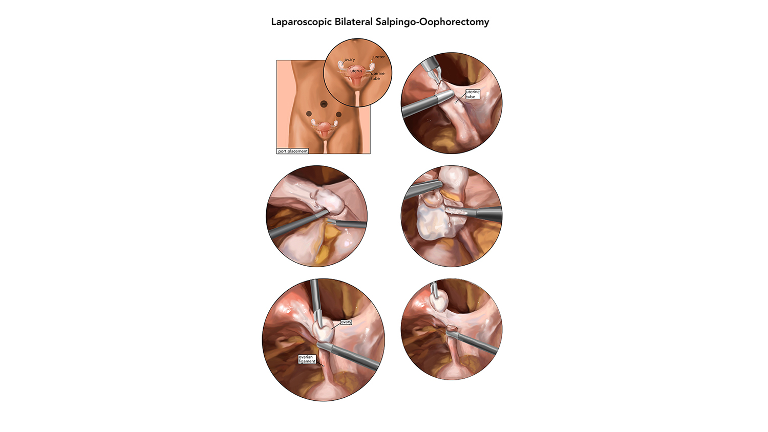 An illustration of an oophorectomy 