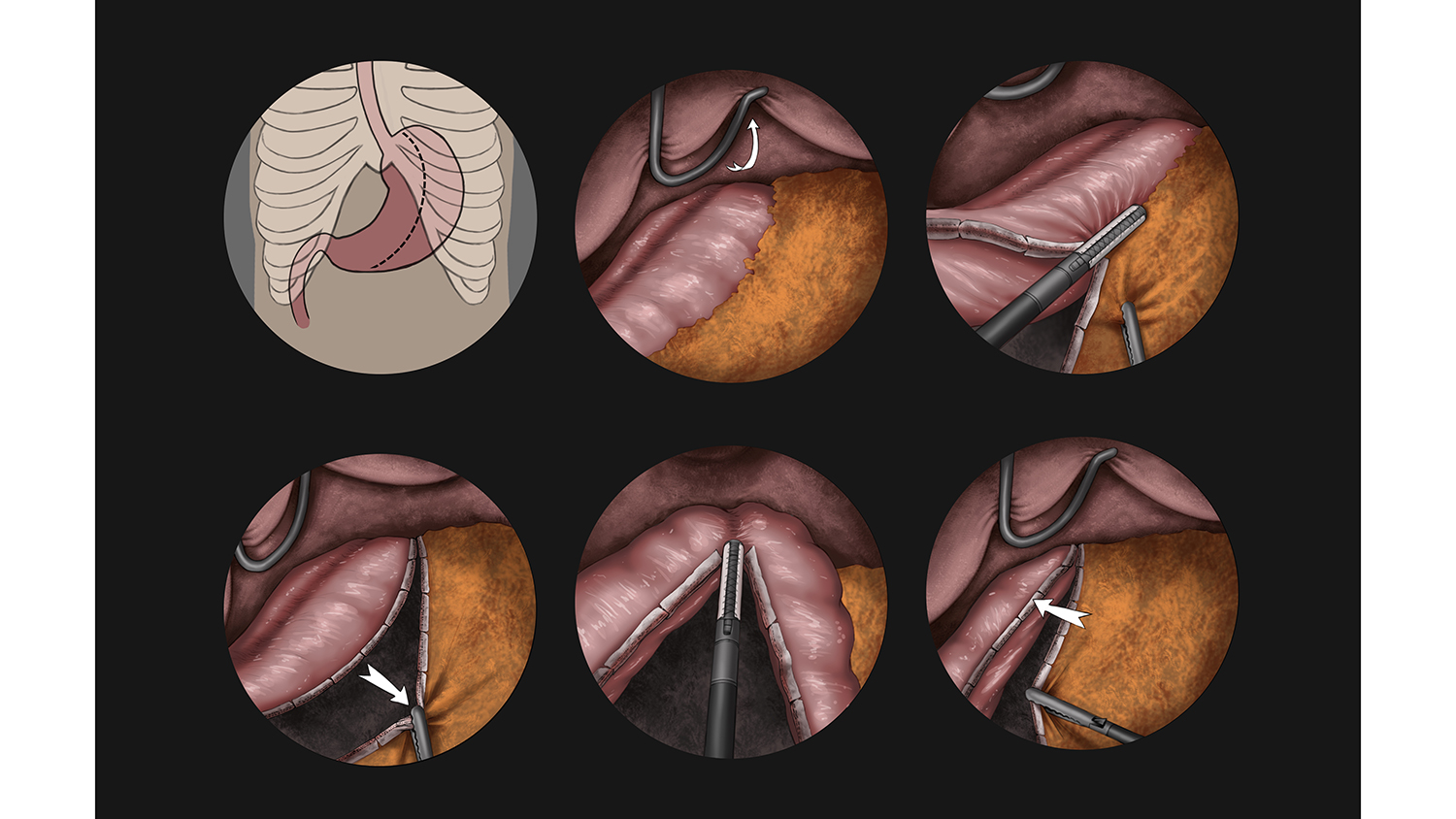 An illustration of a laparoscopic gastrectomy