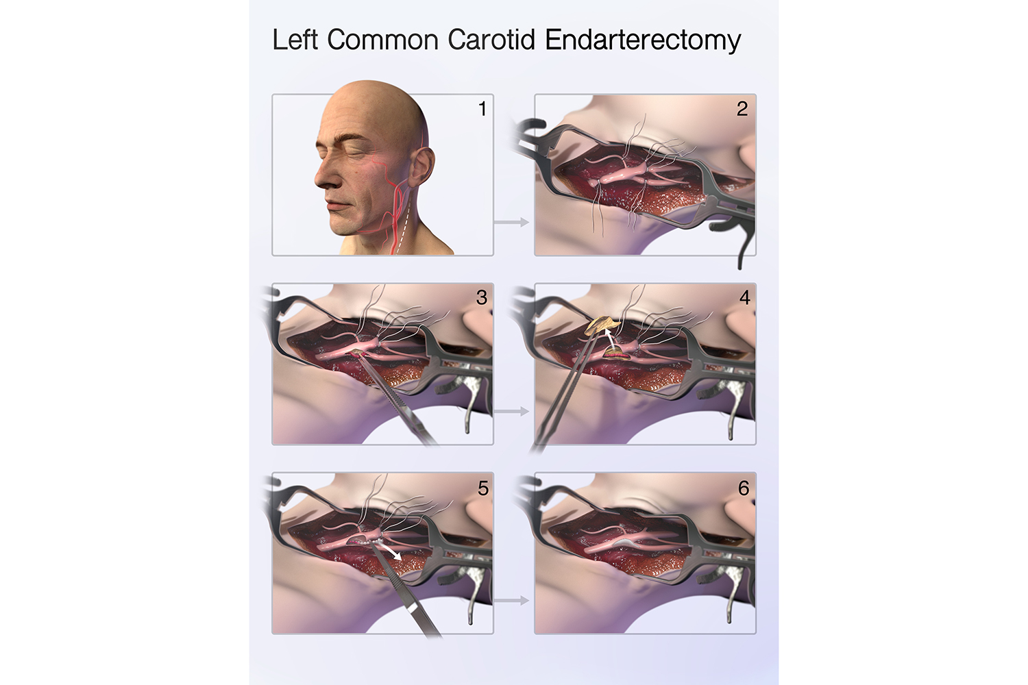 Illustration of a carotid endarterectomy