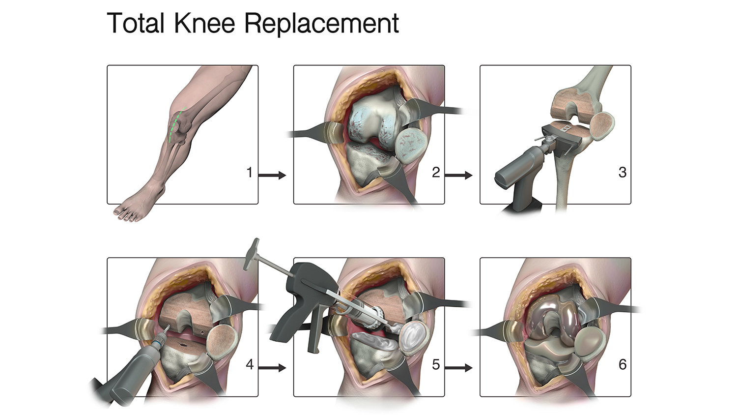 An illustration of a total knee replacement