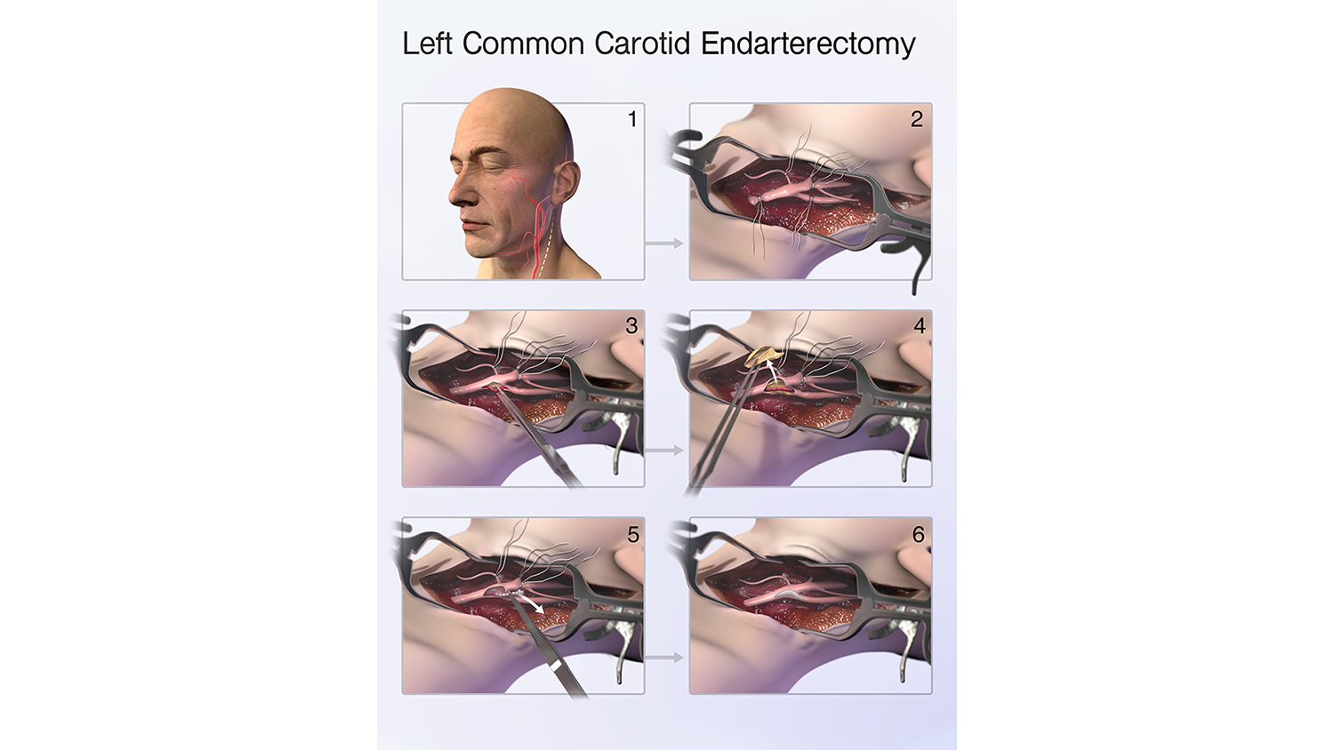 an illustration of a left common carotid endarterectomy
