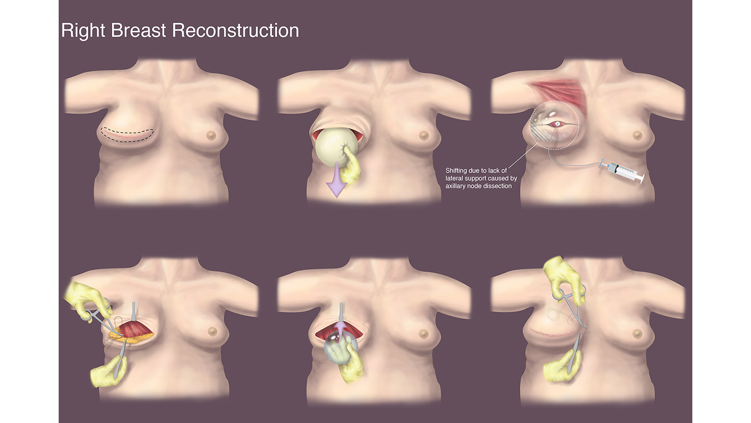 An illustration of a right breast reconstruction 