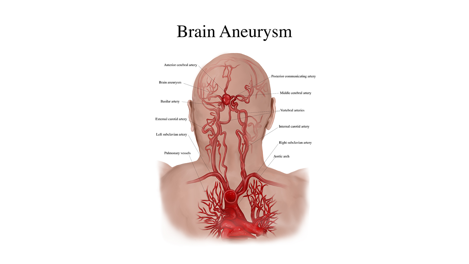 An illustration of a brain aneurysm