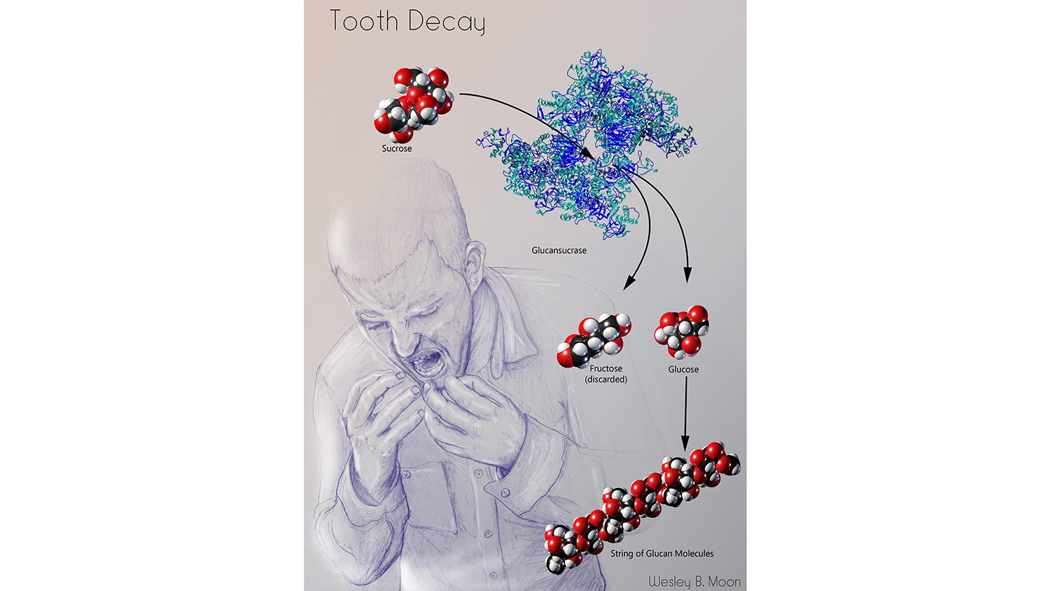 An illustration of tooth decay