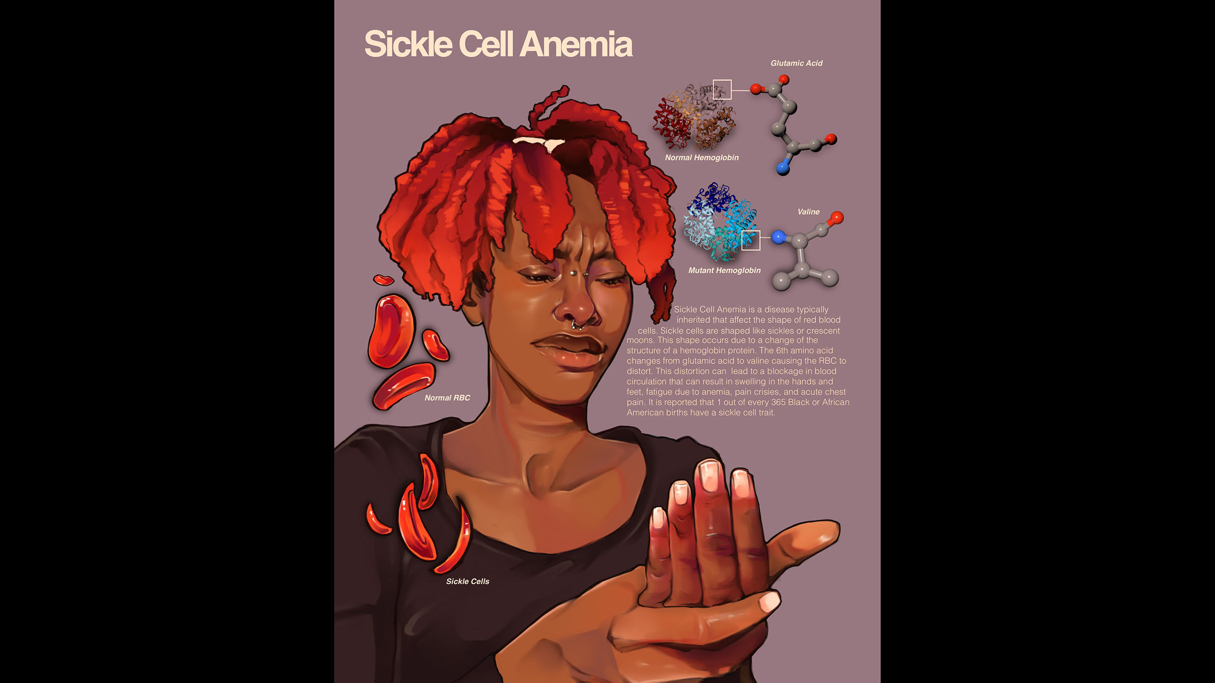 An illustration of sickle cell.