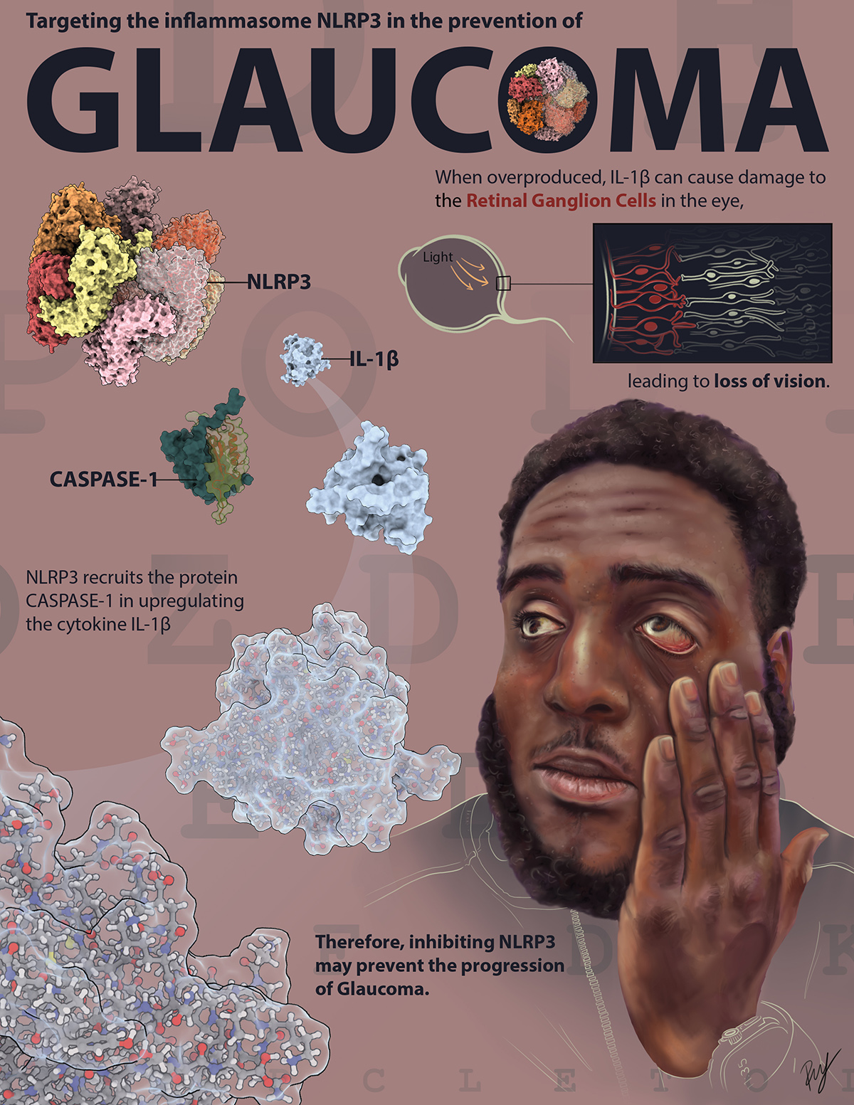 An illustration of the science of glaucoma.