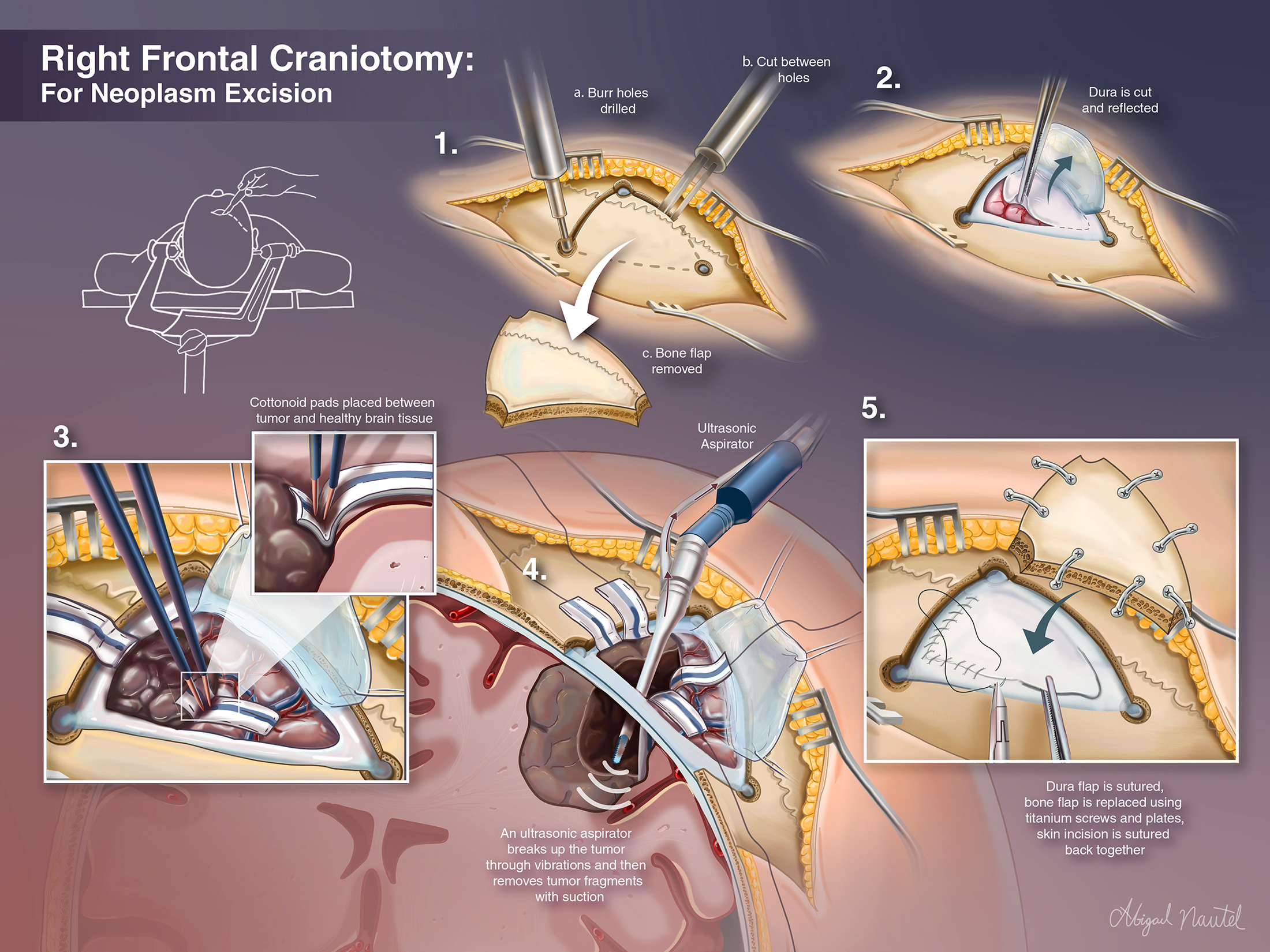 An illustration of a right frontal craniotomy procedure.
